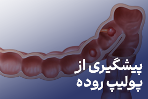 مطالب آموزشی در مورد پیشگیری از پولیپ روده